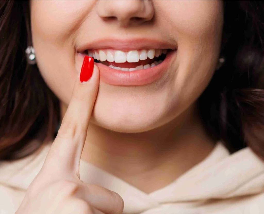 Veneers