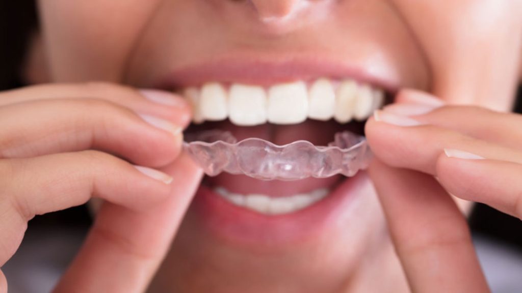 Why SmartTrack™ is the Secret to Faster Invisalign Straightening